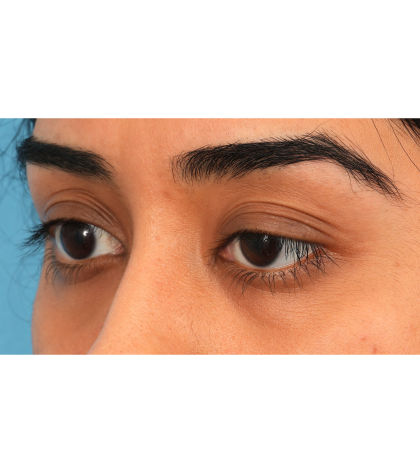 Ptosis Repair Before & After Patient #3024