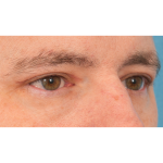 Upper Blepharoplasty Before & After Patient #3062