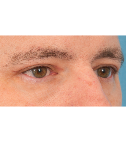 Upper Blepharoplasty Before & After Patient #3062