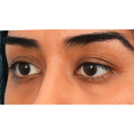 Ptosis Repair Before & After Patient #3024