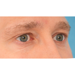 Vein Removal Before & After Patient #3080