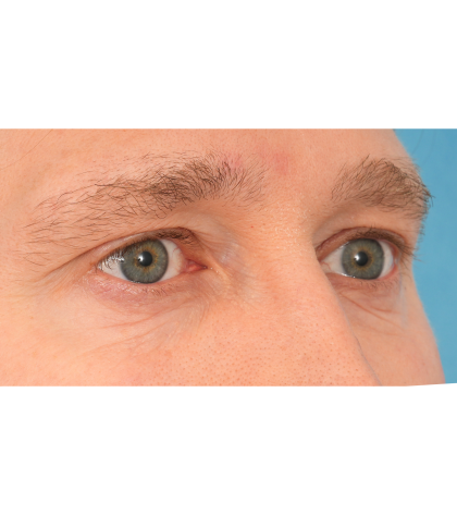 Vein Removal Before & After Patient #3080