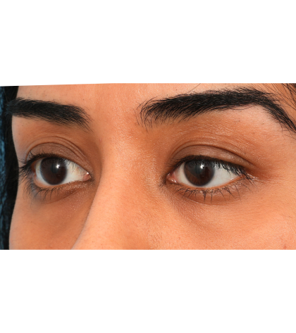 Ptosis Repair Before & After Patient #3024
