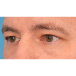 Upper Blepharoplasty Before & After Patient #3062
