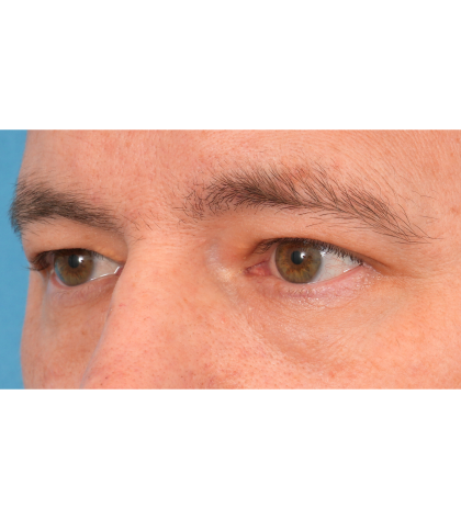 Upper Blepharoplasty Before & After Patient #3062