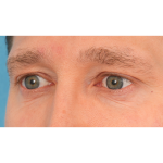 Vein Removal Before & After Patient #3080