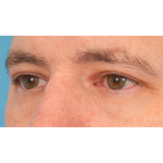 Upper Blepharoplasty Before & After Patient #3062