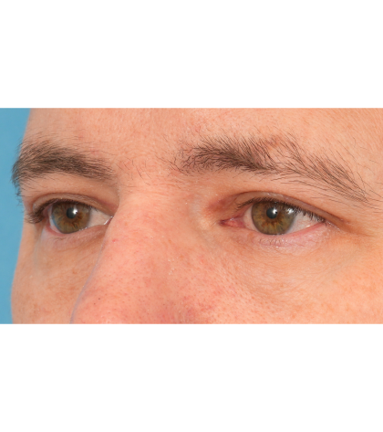 Upper Blepharoplasty Before & After Patient #3062