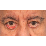 Revision Blepharoplasty Before & After Patient #3111