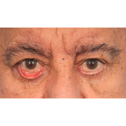 Revision Blepharoplasty Before & After Patient #3111