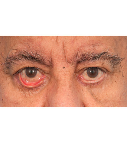 Revision Blepharoplasty Before & After Patient #3111