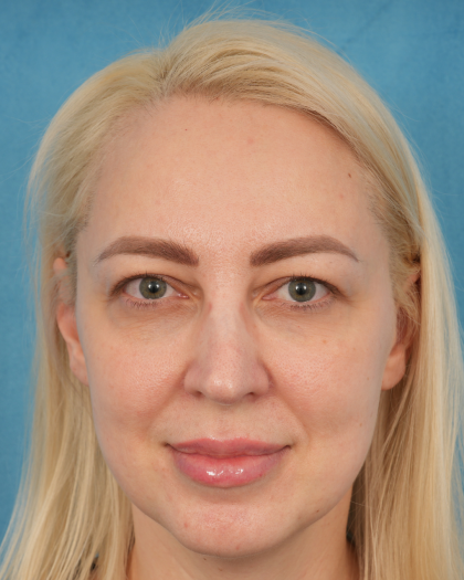 Upper Blepharoplasty Before & After Patient #3120