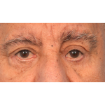Revision Blepharoplasty Before & After Patient #3111