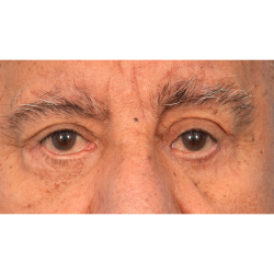 Revision Blepharoplasty Before & After Patient #3111