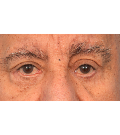 Revision Blepharoplasty Before & After Patient #3111
