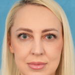 Upper Blepharoplasty Before & After Patient #3120