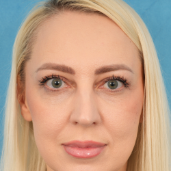 Upper Blepharoplasty Before & After Patient #3120