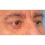 Revision Blepharoplasty Before & After Patient #3111
