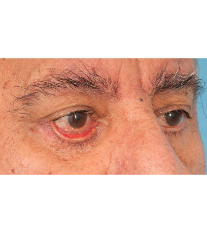 Revision Blepharoplasty Before & After Patient #3111