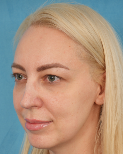 Upper Blepharoplasty Before & After Patient #3120
