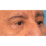 Revision Blepharoplasty Before & After Patient #3111