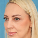 Upper Blepharoplasty Before & After Patient #3120