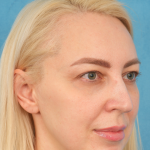 Upper Blepharoplasty Before & After Patient #3120