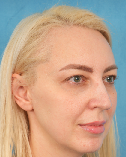 Upper Blepharoplasty Before & After Patient #3120