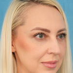 Upper Blepharoplasty Before & After Patient #3120
