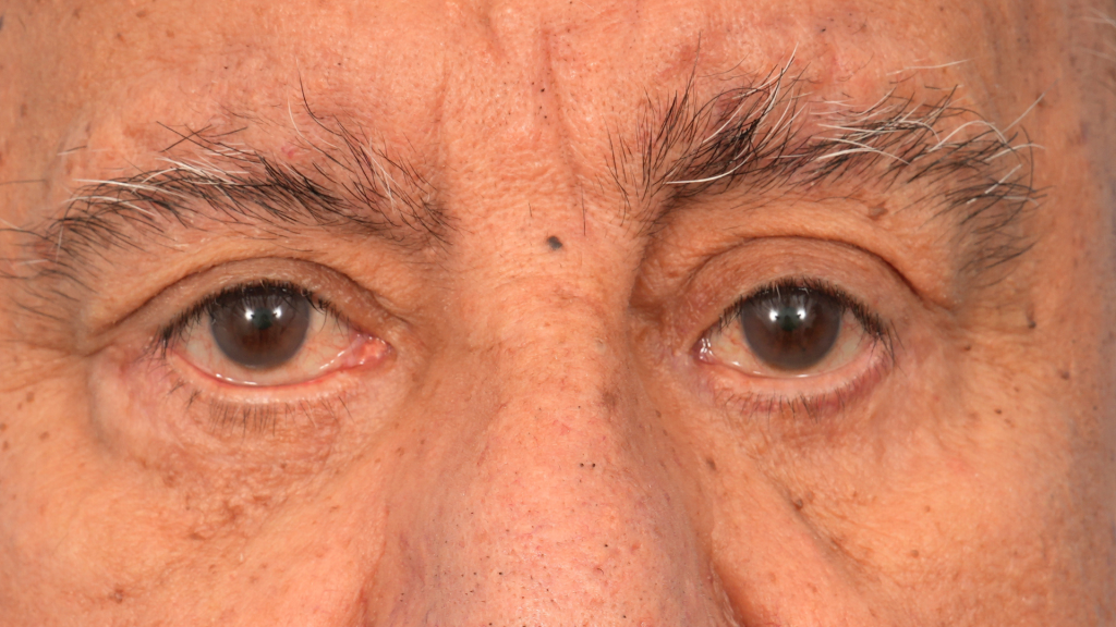 Revision Blepharoplasty
