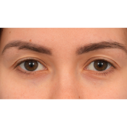 Upper Blepharoplasty Before & After Patient #3165