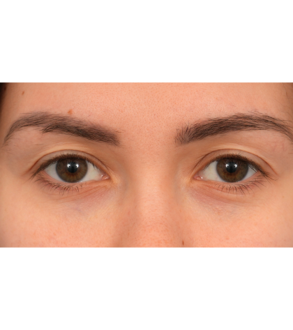 Upper Blepharoplasty Before & After Patient #3165