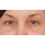 Quad Blepharoplasty Before & After Patient #3197