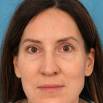 Lower Blepharoplasty Before & After Patient #3153