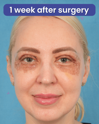 Upper Blepharoplasty Before & After Patient #3120