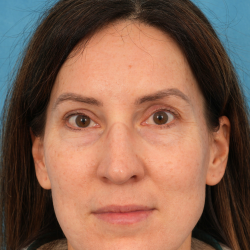 Lower Blepharoplasty Before & After Patient #3153