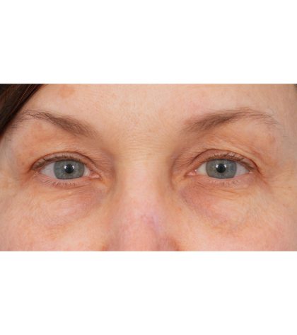 Quad Blepharoplasty Before & After Patient #3197