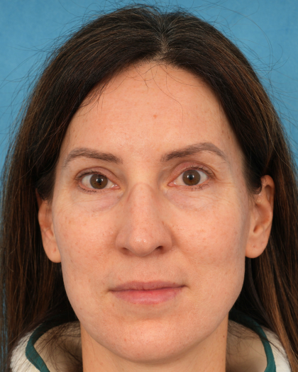Lower Blepharoplasty Before & After Patient #3153