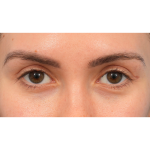 Upper Blepharoplasty Before & After Patient #3165