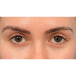 Upper Blepharoplasty Before & After Patient #3165