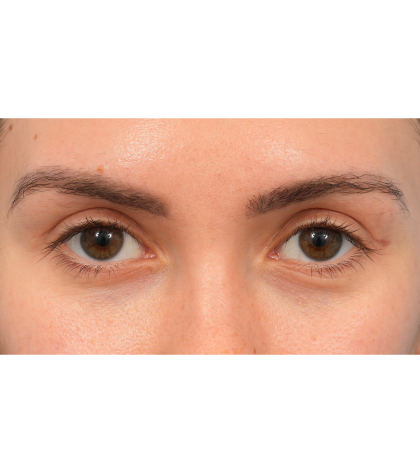 Upper Blepharoplasty Before & After Patient #3165