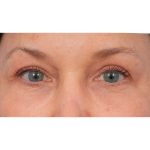Quad Blepharoplasty Before & After Patient #3197