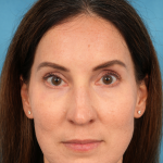 Lower Blepharoplasty Before & After Patient #3153
