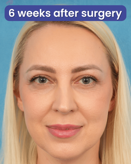 Upper Blepharoplasty Before & After Patient #3120