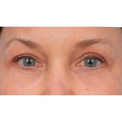Quad Blepharoplasty Before & After Patient #3197