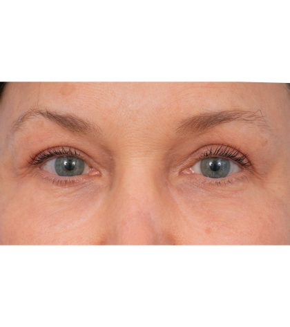 Quad Blepharoplasty Before & After Patient #3197