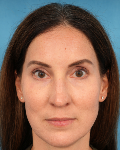 Lower Blepharoplasty Before & After Patient #3153