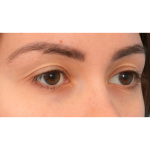 Upper Blepharoplasty Before & After Patient #3165