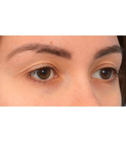 Upper Blepharoplasty Before & After Patient #3165