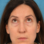 Lower Blepharoplasty Before & After Patient #3153